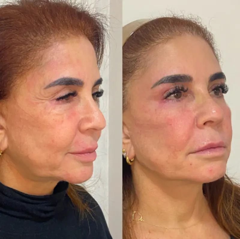 Antes e depois — caso 03