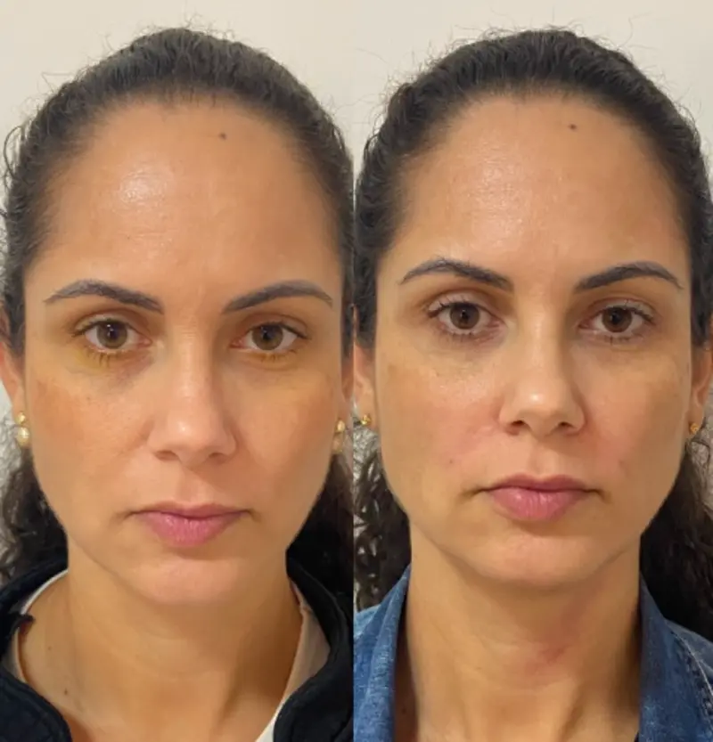 Antes e depois — caso 04